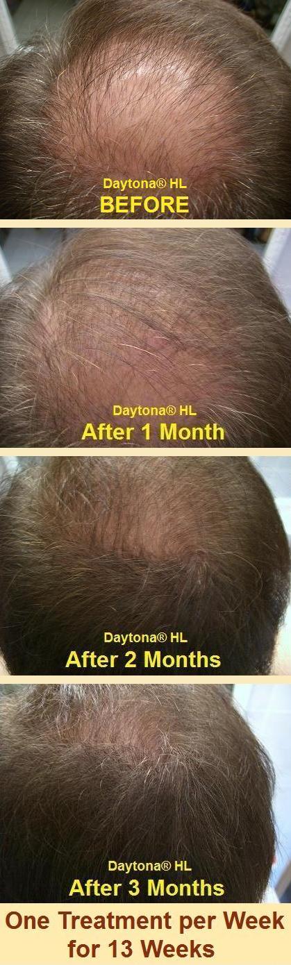 Daytona HL Anti Hair Loss Serum  sales@daytonalabs.com for wholesale price