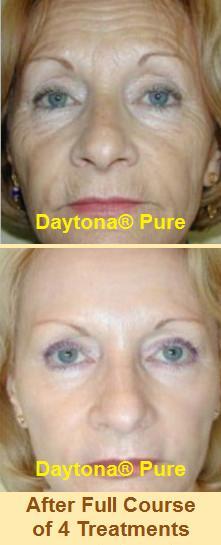 Daytona Pure Non Cross Linked Hyaluronic Acid Gel